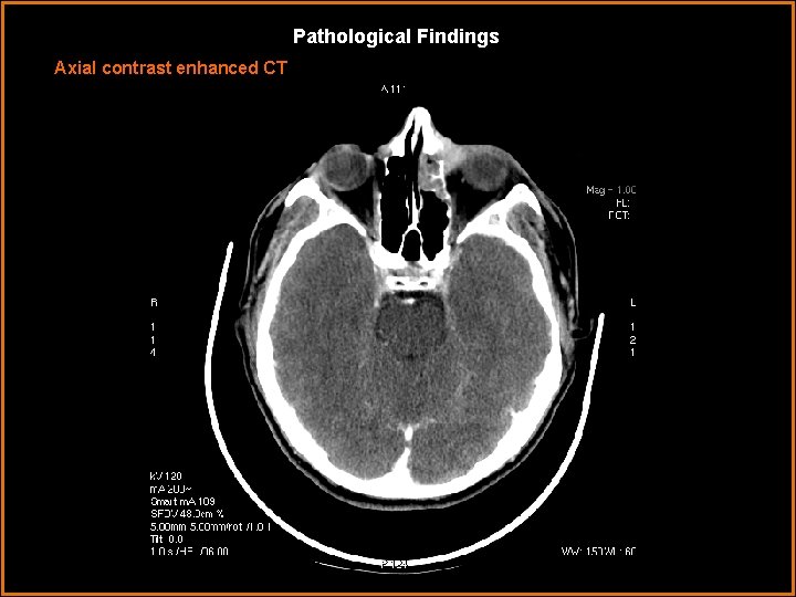Pathological Findings Axial contrast enhanced CT 