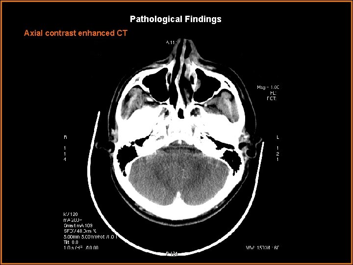 Pathological Findings Axial contrast enhanced CT 