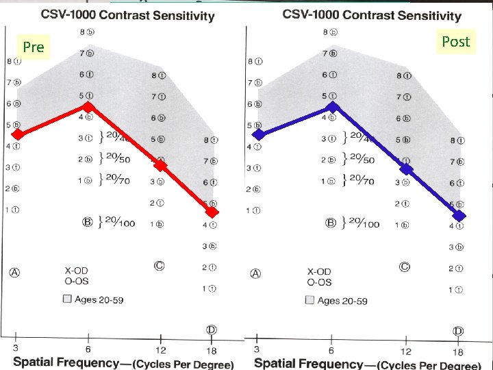 Pre Contrast Sensitivity Post Pre Contrast Sensitivity Post