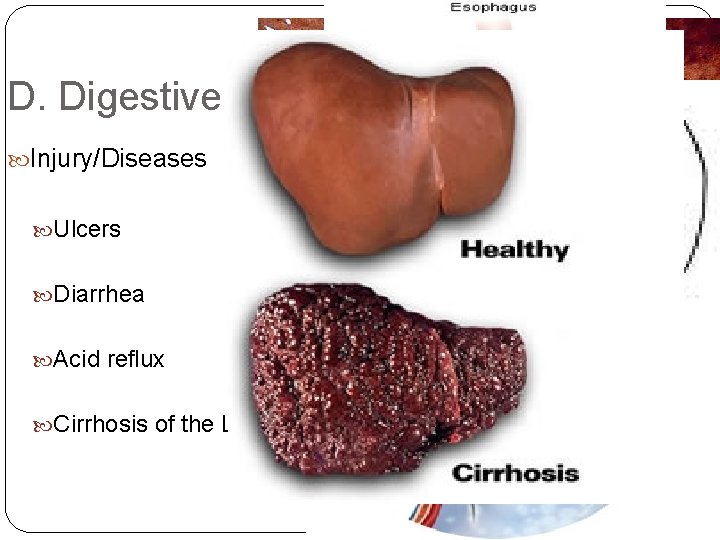 D. Digestive System Injury/Diseases Ulcers Diarrhea Acid reflux Cirrhosis of the Liver 
