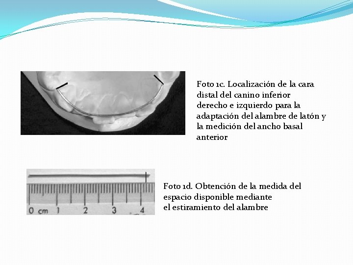 Foto 1 c. Localización de la cara distal del canino inferior derecho e izquierdo