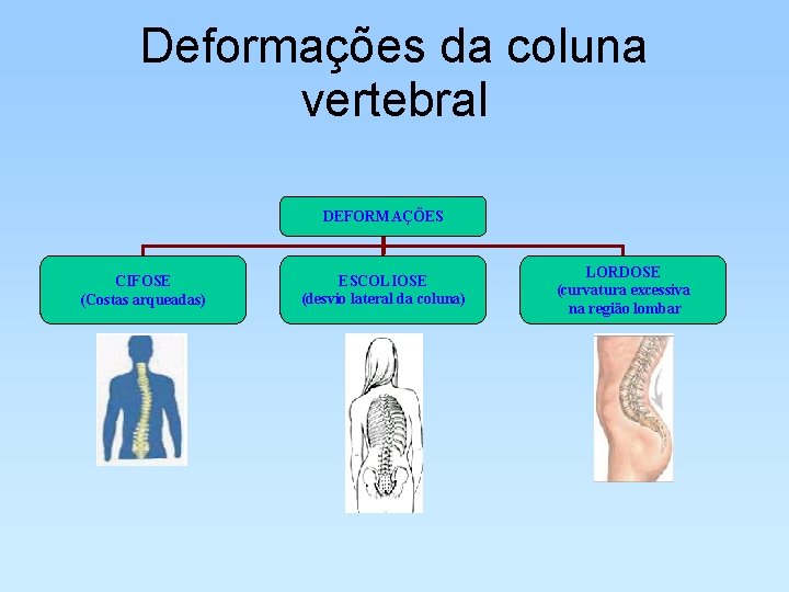 Deformações da coluna vertebral DEFORMAÇÕES CIFOSE (Costas arqueadas) ESCOLIOSE (desvio lateral da coluna) LORDOSE