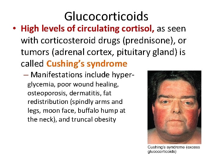 Glucocorticoids • High levels of circulating cortisol, as seen with corticosteroid drugs (prednisone), or