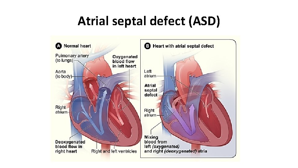 Atrial septal defect (ASD) 