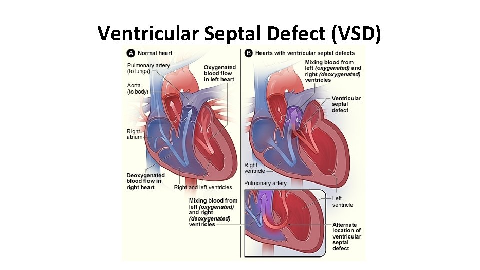Ventricular Septal Defect (VSD) 