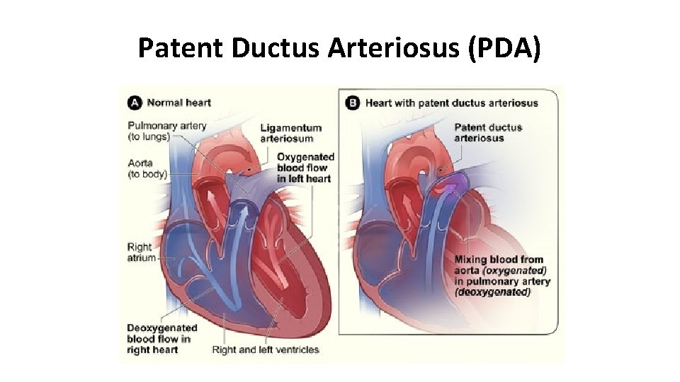 Patent Ductus Arteriosus (PDA) 