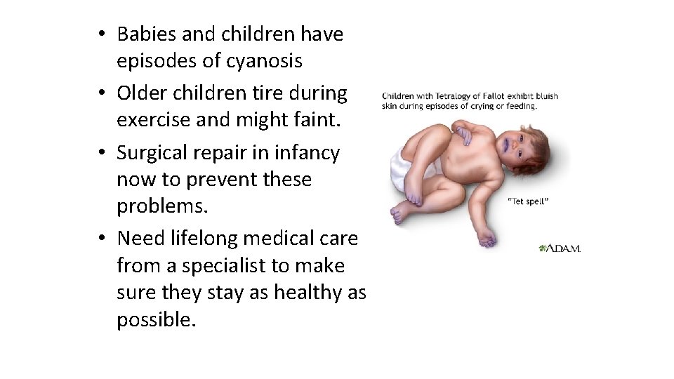  • Babies and children have episodes of cyanosis • Older children tire during
