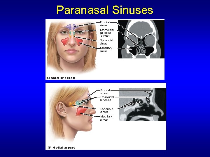 Paranasal Sinuses Frontal sinus Ethmoidal air cells (sinus) Sphenoid sinus Maxillary sinus (a) Anterior