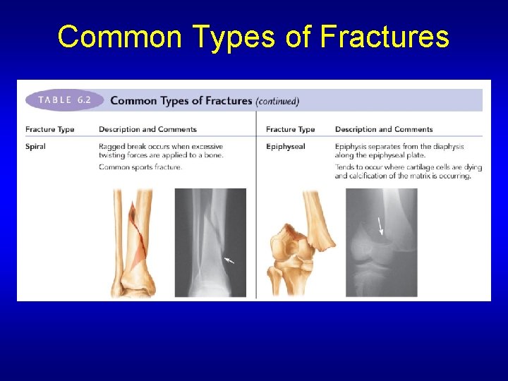 Common Types of Fractures 