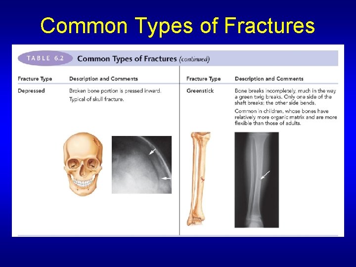 Common Types of Fractures 
