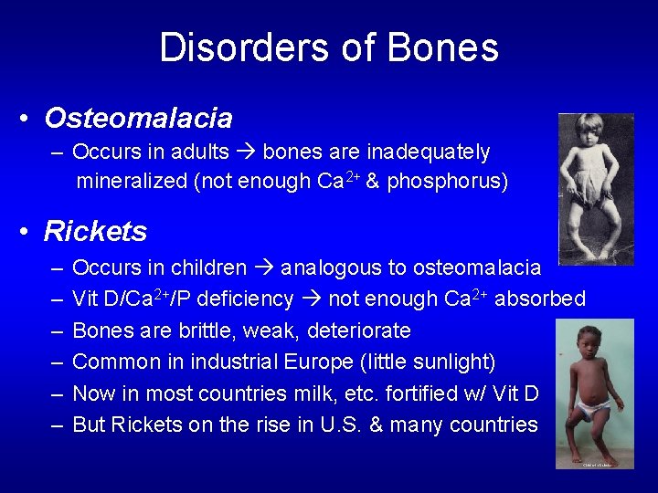 Disorders of Bones • Osteomalacia – Occurs in adults bones are inadequately mineralized (not