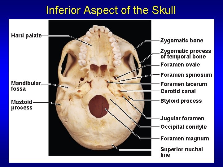 Inferior Aspect of the Skull Hard palate Zygomatic bone Zygomatic process of temporal bone