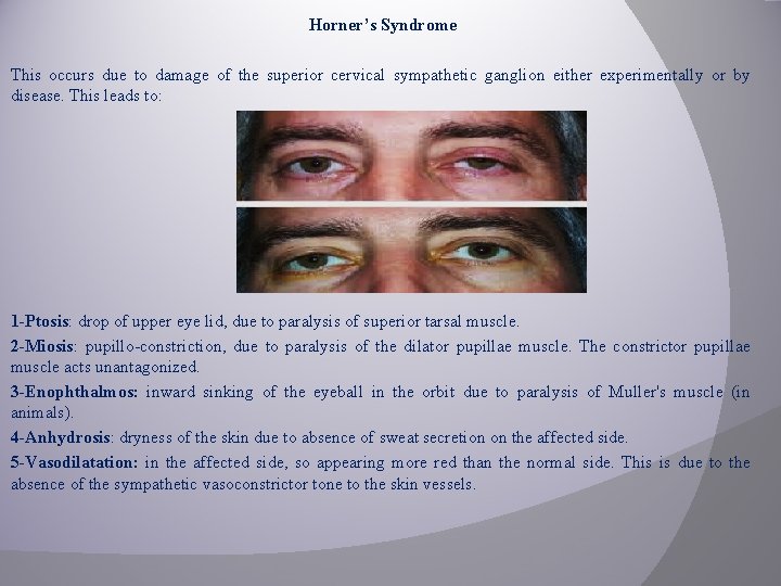 Horner’s Syndrome This occurs due to damage of the superior cervical sympathetic ganglion either