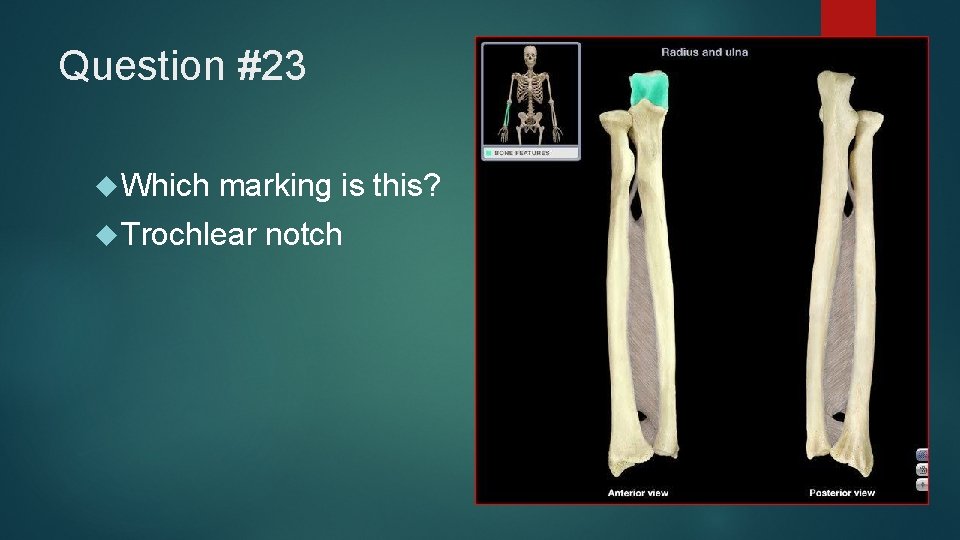 Question #23 Which marking is this? Trochlear notch 
