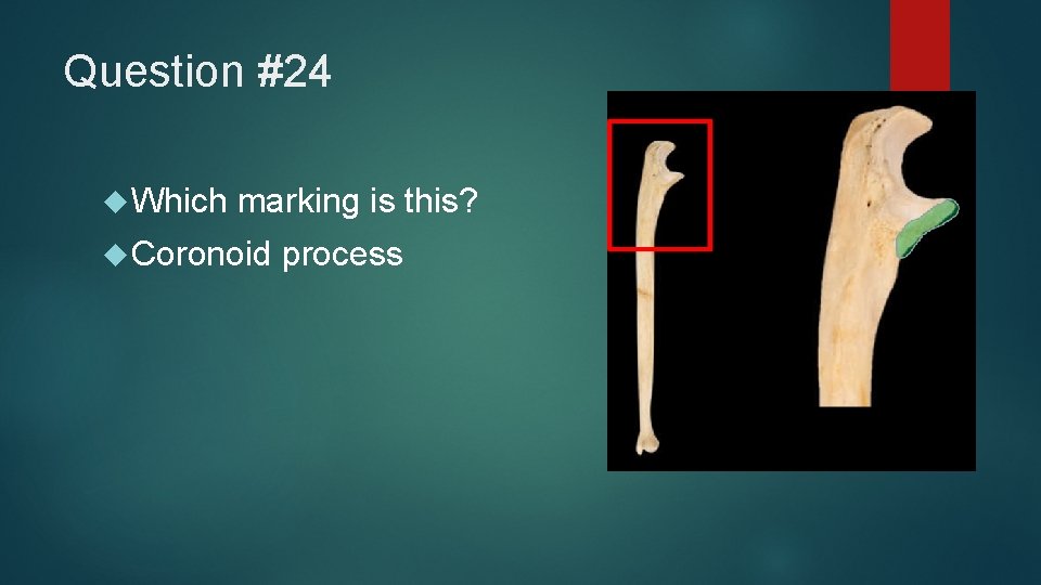 Question #24 Which marking is this? Coronoid process 