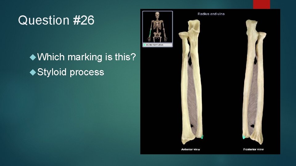 Question #26 Which marking is this? Styloid process 