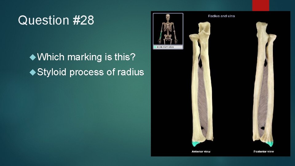 Question #28 Which marking is this? Styloid process of radius 
