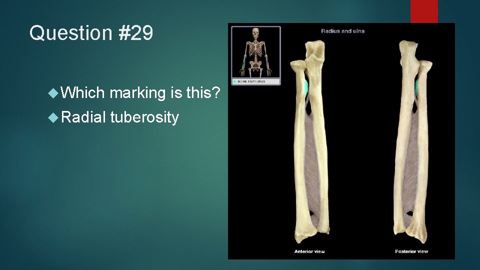 Question #29 Which marking is this? Radial tuberosity 