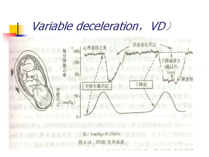 Variable deceleration，VD） 