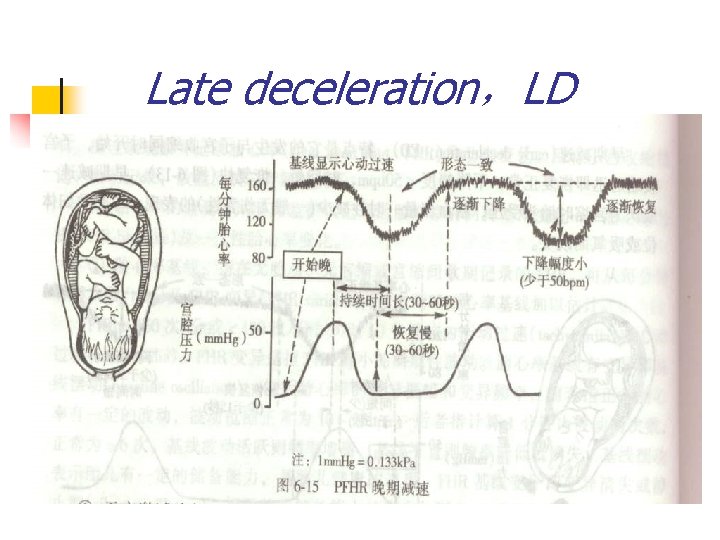Late deceleration，LD 