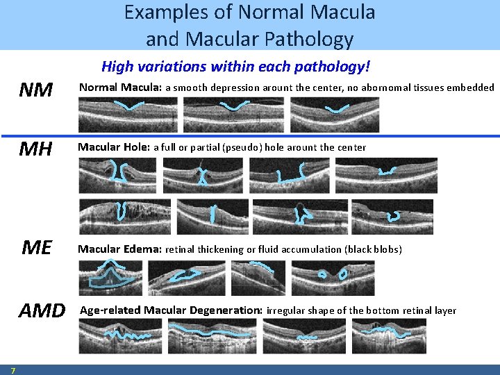 Examples of Normal Macula and Macular Pathology 7 High variations within each pathology! NM