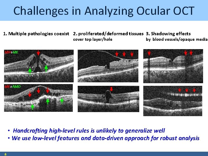 Challenges in Analyzing Ocular OCT 1. Multiple pathologies coexist 2. proliferated/deformed tissues 3. Shadowing