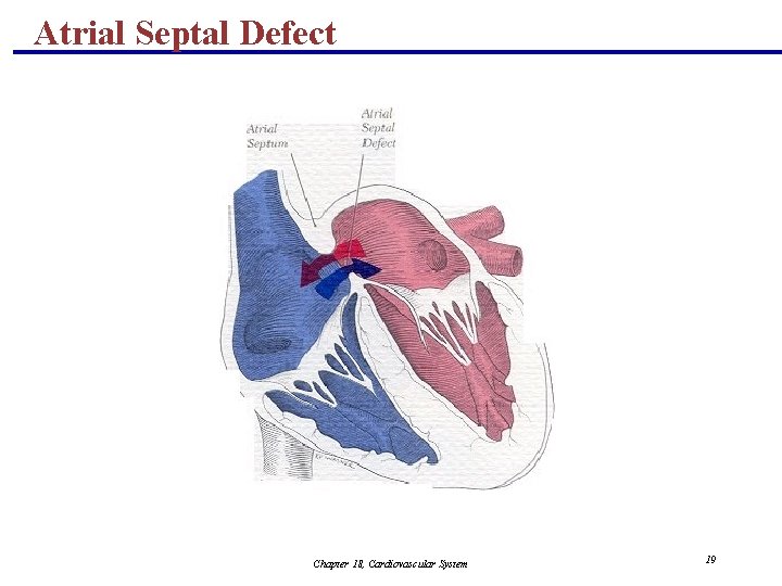 Atrial Septal Defect Chapter 18, Cardiovascular System 19 
