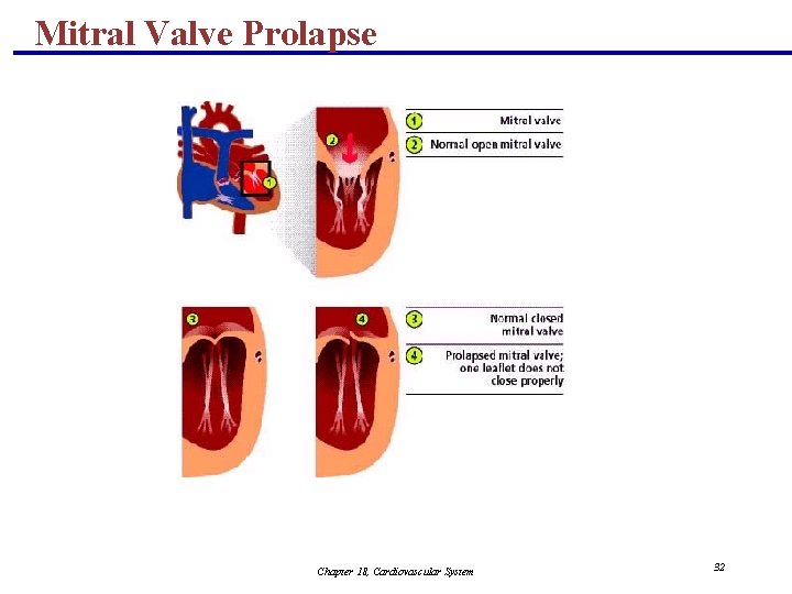 Mitral Valve Prolapse Chapter 18, Cardiovascular System 32 