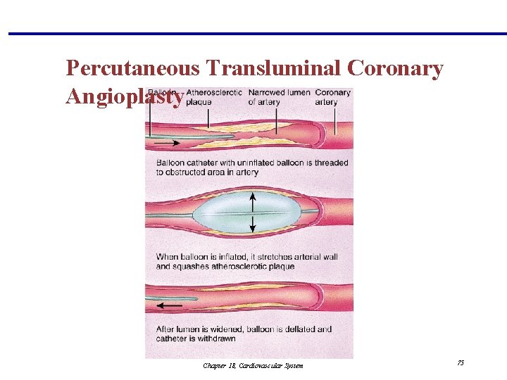 Percutaneous Transluminal Coronary Angioplasty Chapter 18, Cardiovascular System 75 