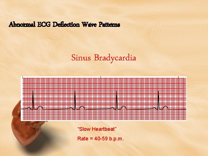 Abnormal ECG Deflection Wave Patterns Sinus Bradycardia “Slow Heartbeat” Rate = 40 -59 b.