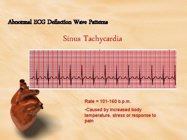 Abnormal ECG Deflection Wave Patterns Sinus Tachycardia Rate = 101 -160 b. p. m.