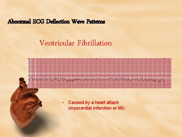 Abnormal ECG Deflection Wave Patterns Ventricular Fibrillation • Caused by a heart attack (myocardial