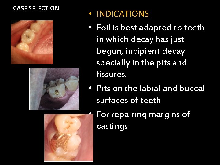 CASE SELECTION • INDICATIONS • Foil is best adapted to teeth in which decay