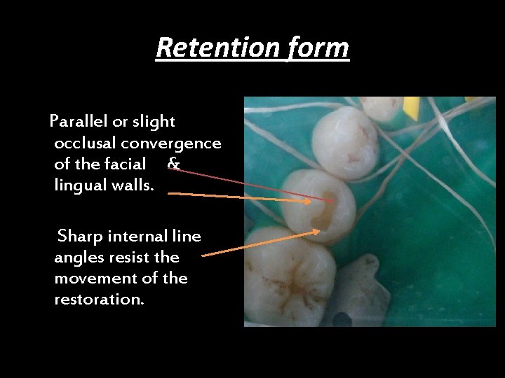 Retention form Parallel or slight occlusal convergence of the facial & lingual walls. Sharp