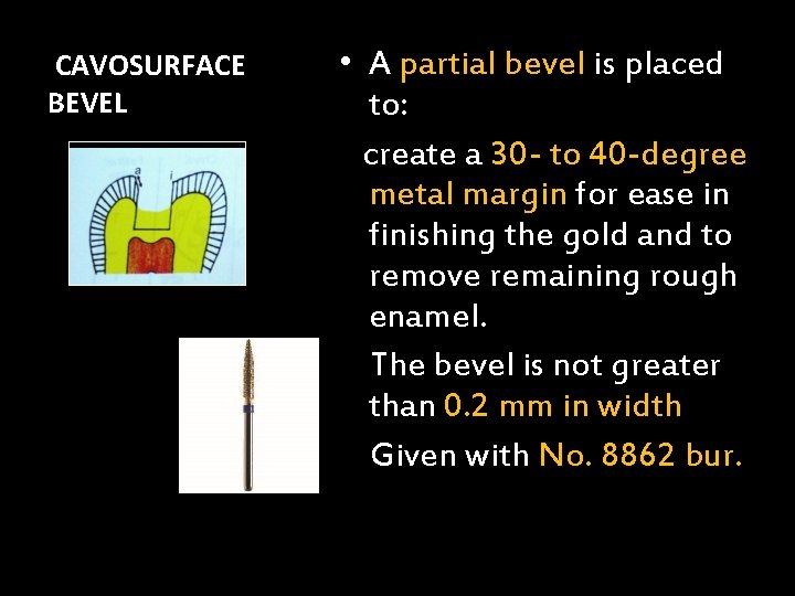 CAVOSURFACE BEVEL • A partial bevel is placed to: create a 30 - to