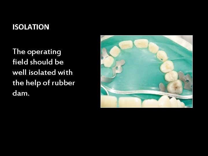 ISOLATION The operating field should be well isolated with the help of rubber dam.