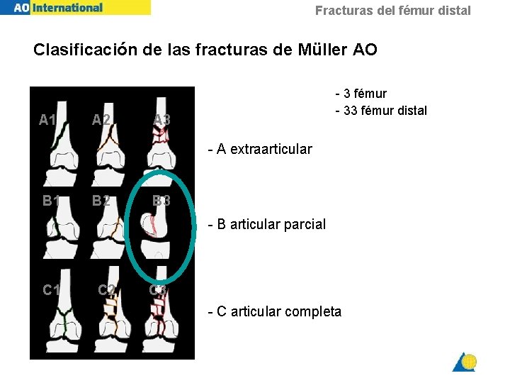 Fracturas del fmur distal Dave Hak Sacramento USA
