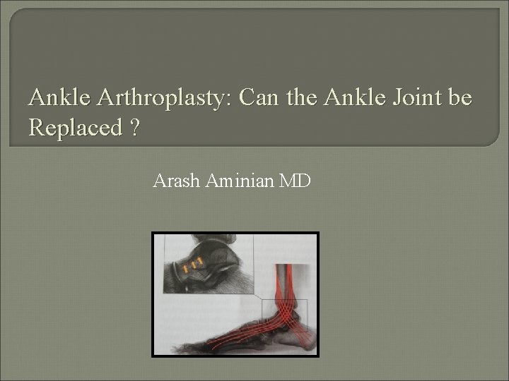 Ankle Arthroplasty: Can the Ankle Joint be Replaced ? Arash Aminian MD 