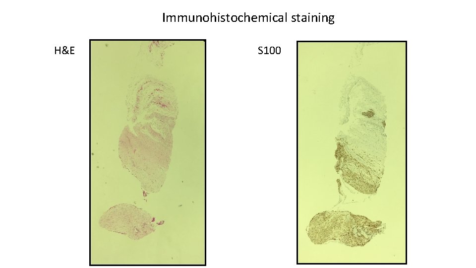 Immunohistochemical staining H&E S 100 