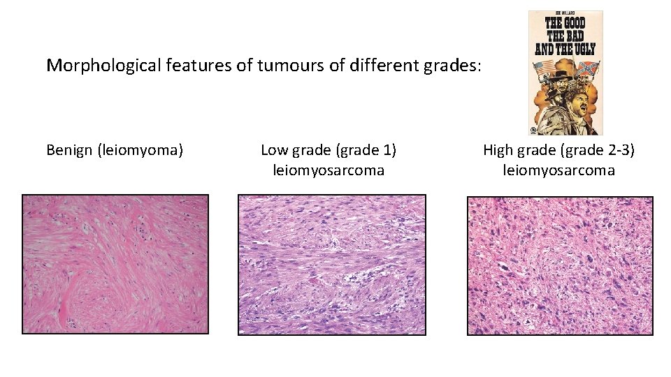 Morphological features of tumours of different grades: Benign (leiomyoma) Low grade (grade 1) leiomyosarcoma