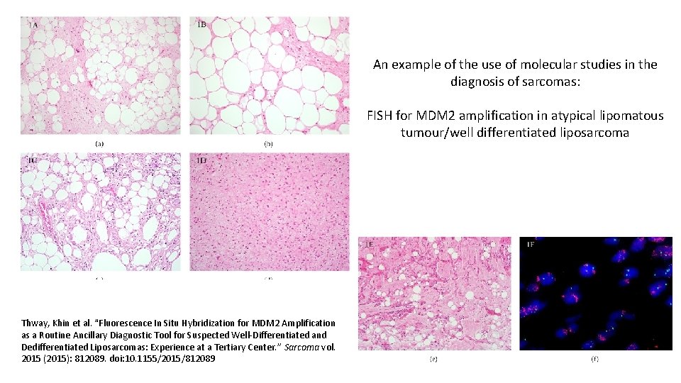 An example of the use of molecular studies in the diagnosis of sarcomas: FISH