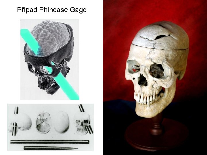 Případ Phinease Gage 