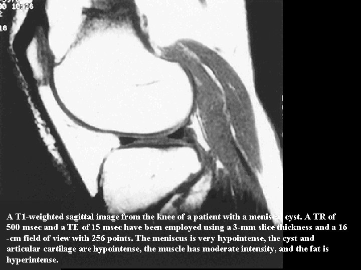 A T 1 -weighted sagittal image from the knee of a patient with a