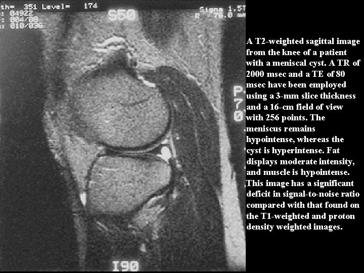 A T 2 -weighted sagittal image from the knee of a patient with a