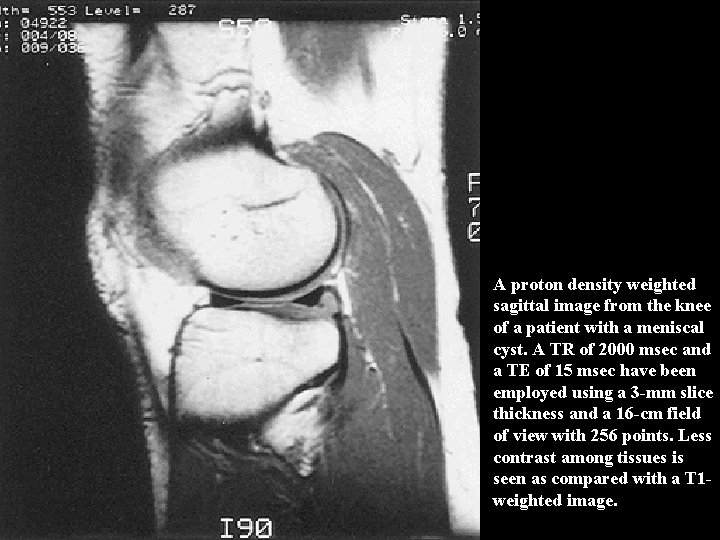 A proton density weighted sagittal image from the knee of a patient with a