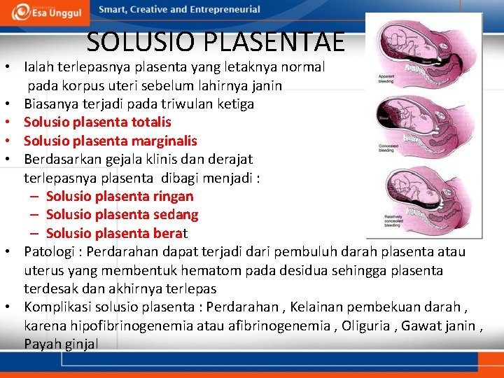 SOLUSIO PLASENTAE • Ialah terlepasnya plasenta yang letaknya normal pada korpus uteri sebelum lahirnya