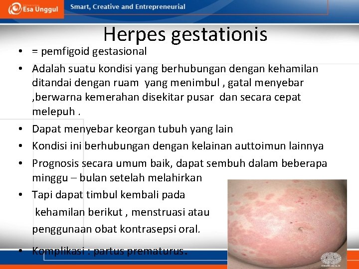 Herpes gestationis • = pemfigoid gestasional • Adalah suatu kondisi yang berhubungan dengan kehamilan
