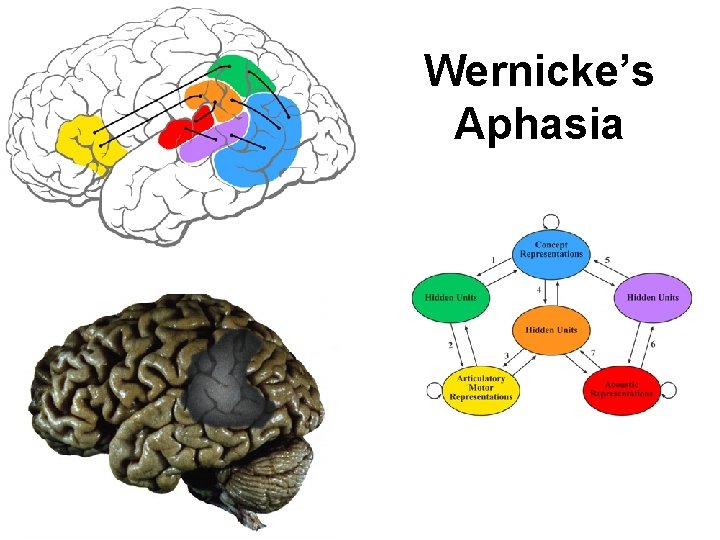 Wernicke’s Aphasia 