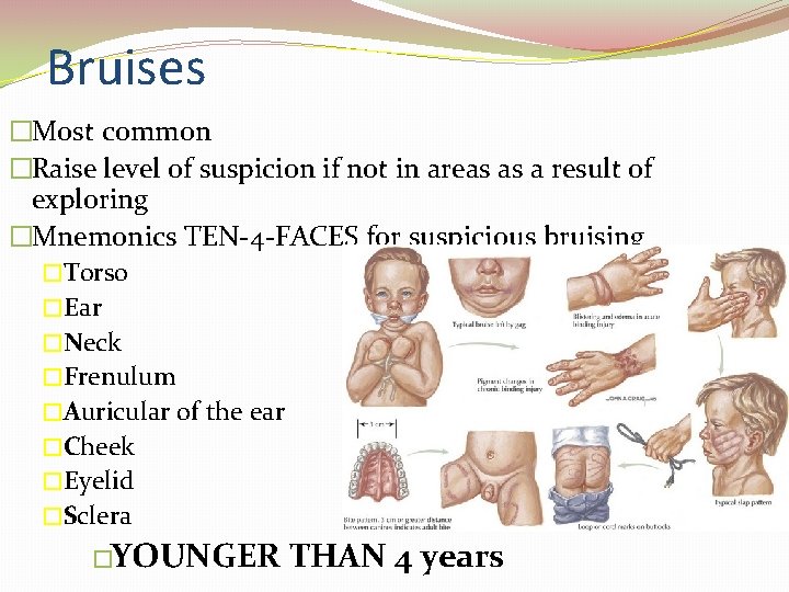 Bruises �Most common �Raise level of suspicion if not in areas as a result