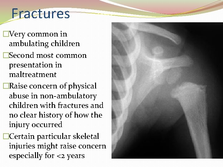 Fractures �Very common in ambulating children �Second most common presentation in maltreatment �Raise concern